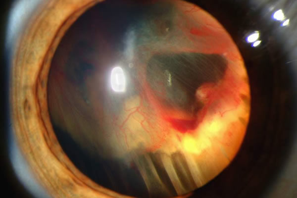 Retinal Detachment elean opticians ctyprus